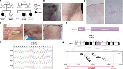 Case Report: ISG15 deficiency caused by novel variants in two families and effective treatment with Janus kinase inhibition